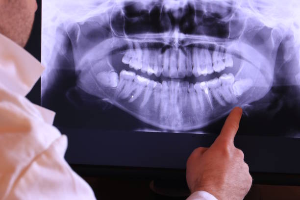 Best Dental Abscess Treatment in Starkville, MS